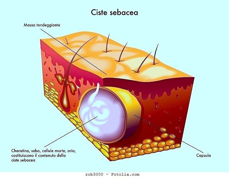 ClioMakeUp-papule-pustole-cisti-come-trattarle-prodotti-specifici-cisti