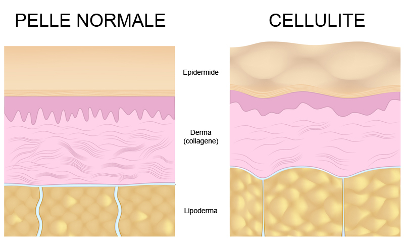 Cliomakeup-ritenzione-idrica-cellulite-rimedi-18