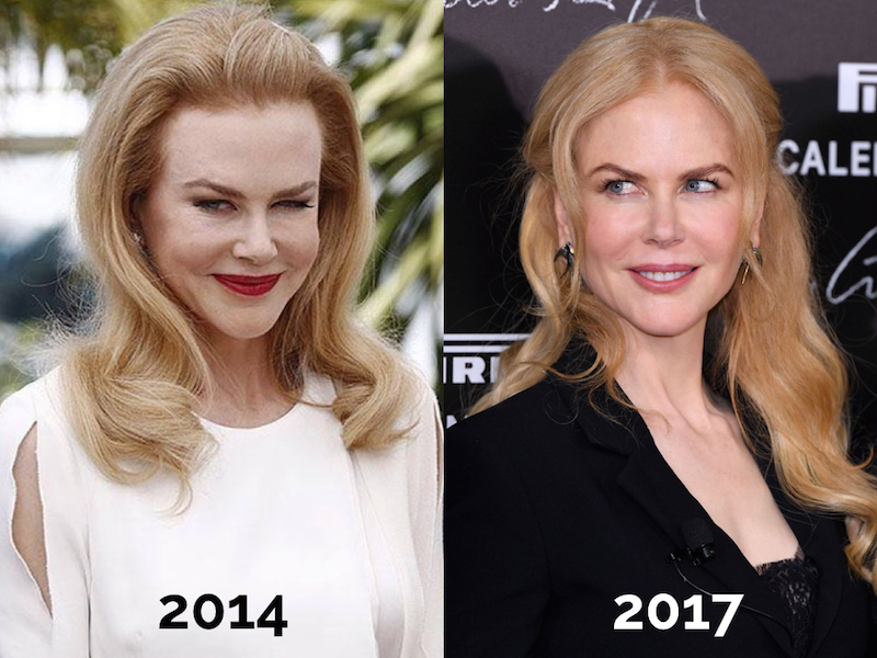 ClioMakeUp-nicole-kidman-prima-dopo-botox-disintossicata-oggi-2017.001