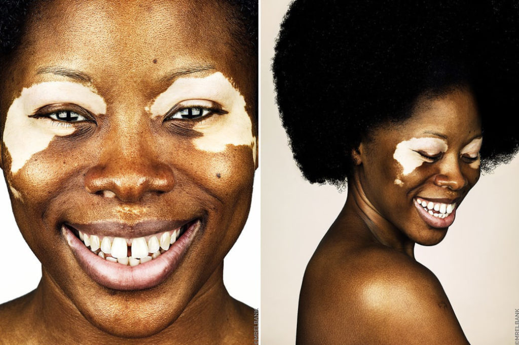 cliomakeup-brock-elbank-vitiligo-1