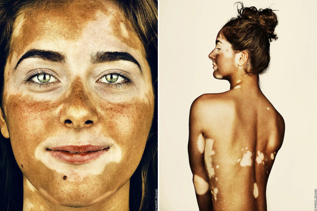 cliomakeup-brock-elbank-vitiligo-11