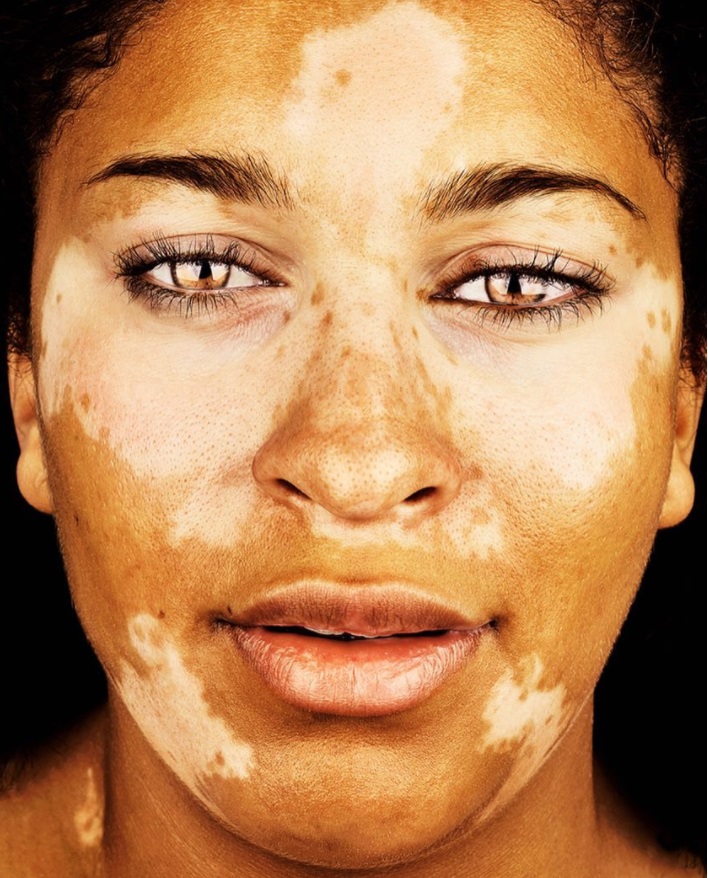 cliomakeup-brock-elbank-vitiligo-13