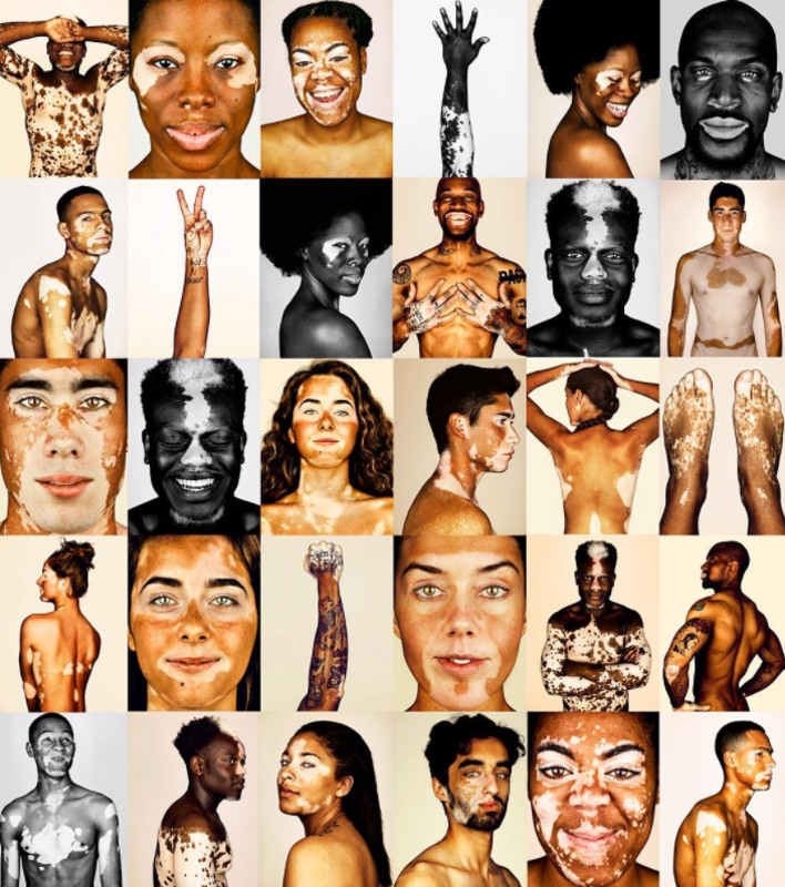 cliomakeup-brock-elbank-vitiligo-14