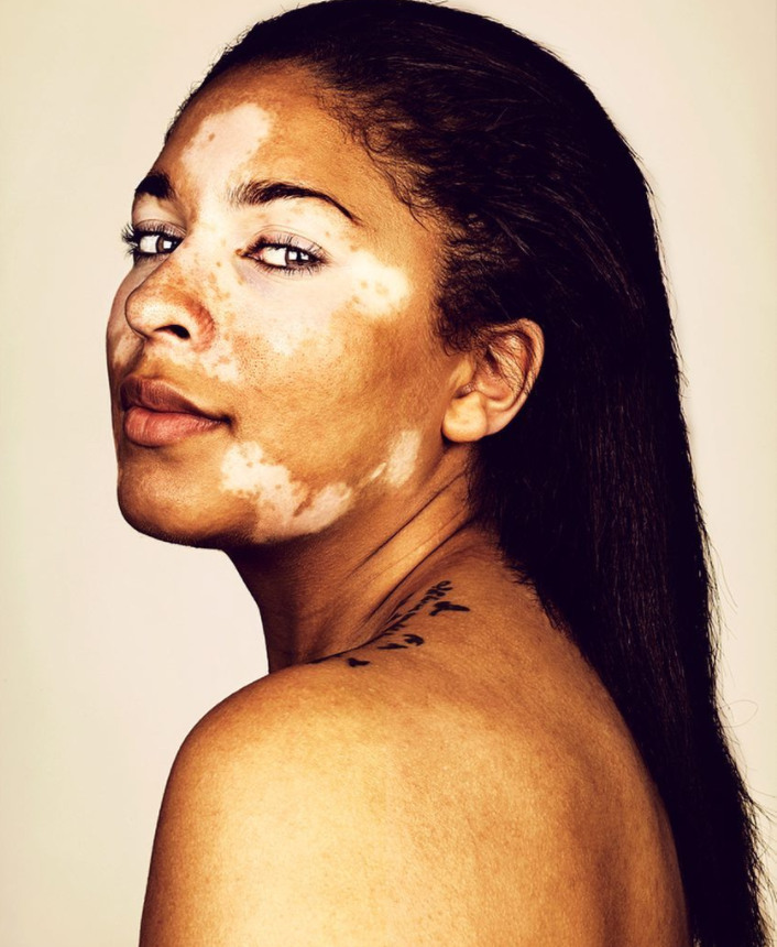 cliomakeup-brock-elbank-vitiligo-16