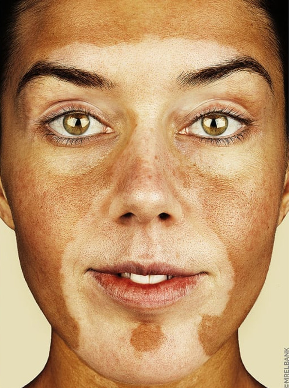 cliomakeup-brock-elbank-vitiligo-17