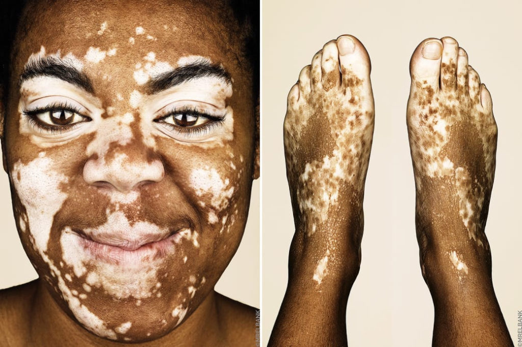 cliomakeup-brock-elbank-vitiligo-3