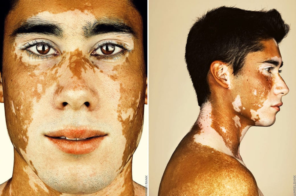 cliomakeup-brock-elbank-vitiligo-4