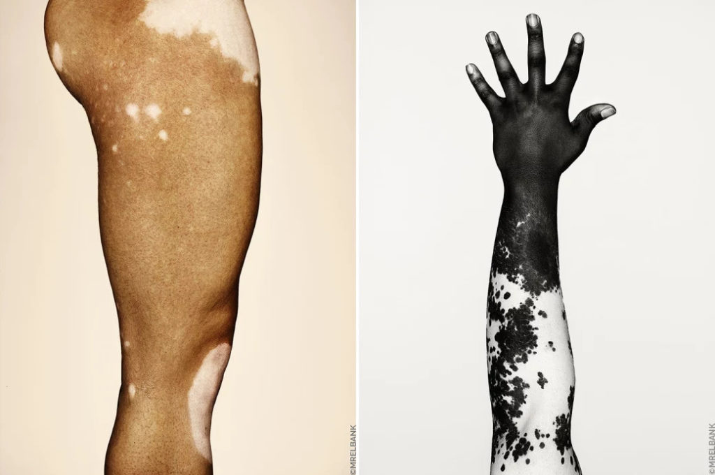 cliomakeup-brock-elbank-vitiligo-9