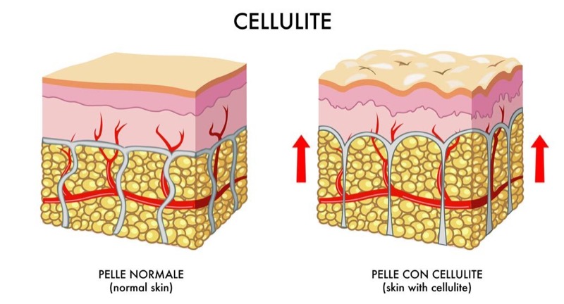 cliomakeup-ritenzione-idrica-cellulite-13-formazione-cellulite