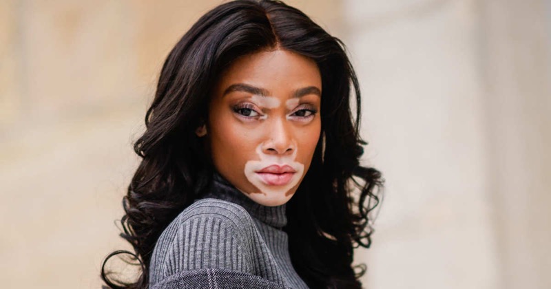 cliomakeup-foto-vitiligine-9-winnie-harlow