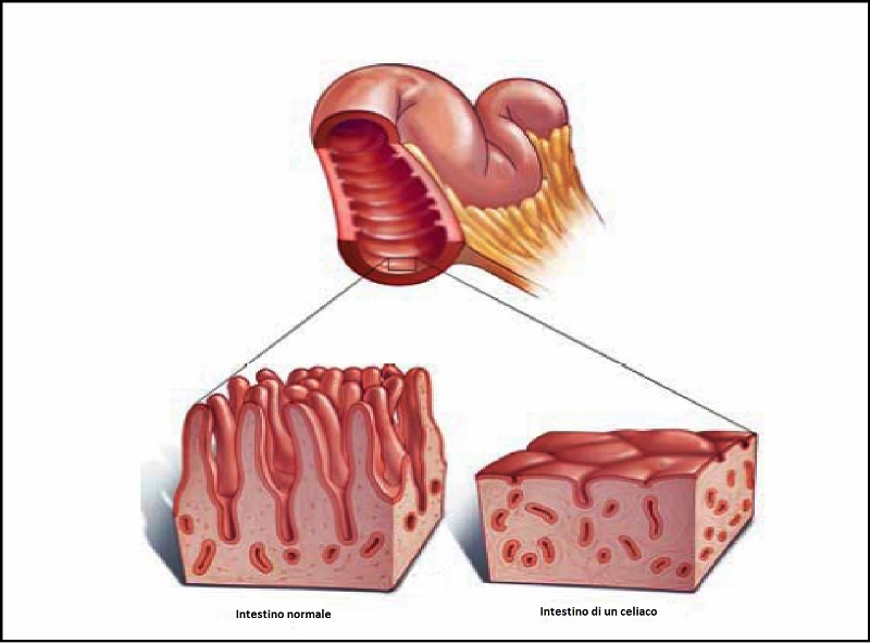 cliomakeup-celiachia-atrofia-villi-intestinali-2