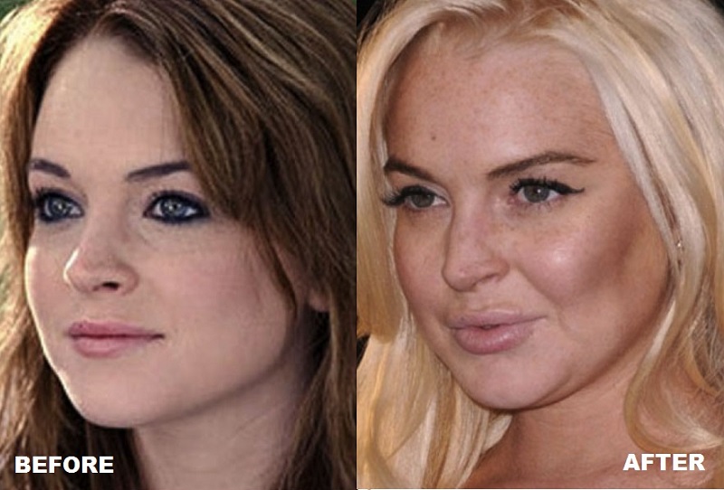 cliomakeup-attrici-seno.rifatto-15-Lindsay-Lohan-before-and-after