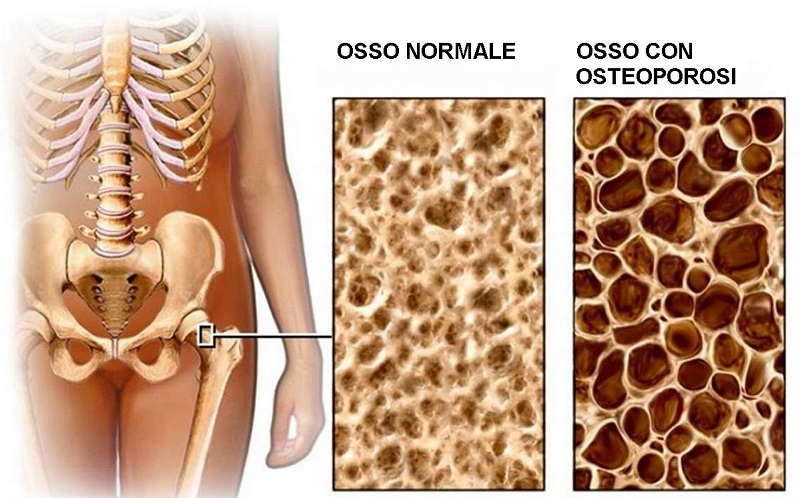 cliomakeup-menopausa-5-osteoporosi