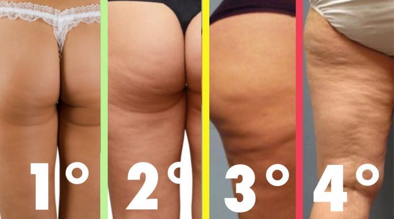 cliomakeup-cellulite-cause-rimedi-9-fasi