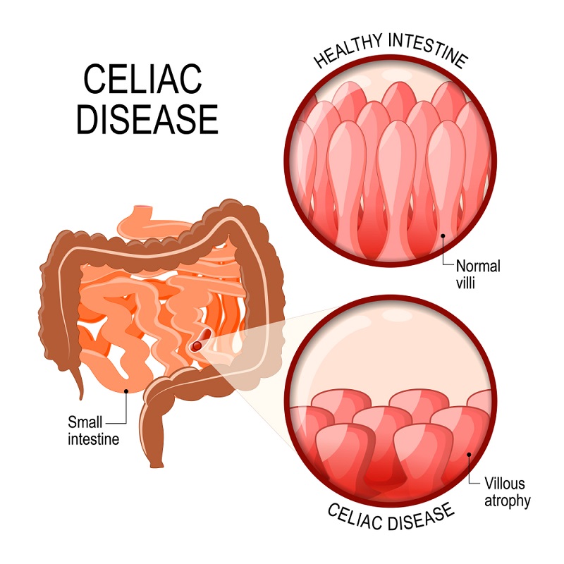 cliomakeup-eliminare-il-glutine-2-celiachia-intestino