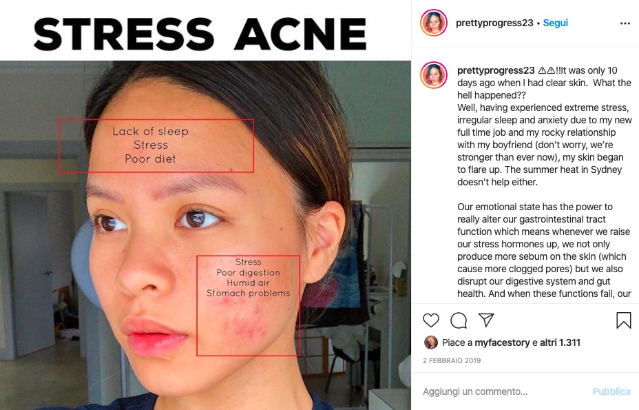 Cliomakeup-acne-da-stress-3-come-rinoscerla