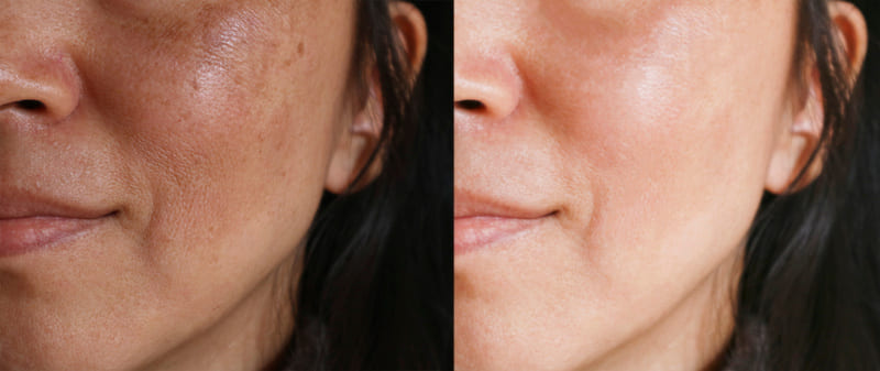 cliomakeup-problemi-pelle-gravidanza-melasma